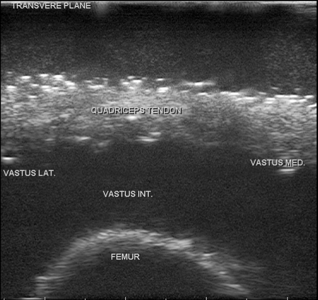 膝關節肌肉骨骼超音波訓練模型超音波影像